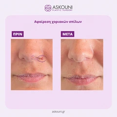 Αφαίρεση Χοριακών Σπίλων - Μύτη | Πριν & Μετά