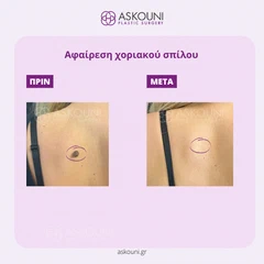 Αφαίρεση Χοριακού Σπίλου - Πλάτη | Πριν & Μετά