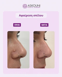 Αφαίρεση Σπίλου - Μύτη - 3 Μήνες Μετά | Πριν & Μετά