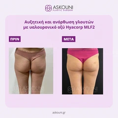 Αυξητική & Ανόρθωση Γλουτών με Υαλουρονικό Οξύ Hyacorp MLF2 | Πριν & Μετά