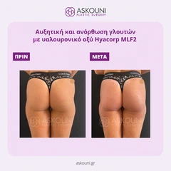 Αυξητική & Ανόρθωση Γλουτών με Υαλουρονικό Οξύ Hyacorp MLF2 | Πριν & Μετά
