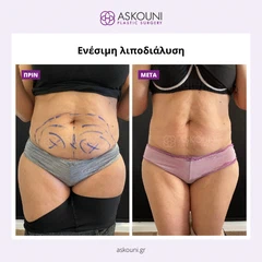 Λιποδιάλυση με Aqualyx - Γυναίκα | Πριν & Μετά