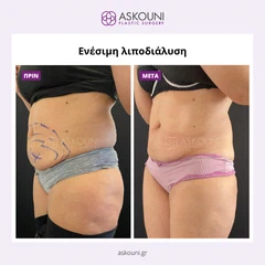 Λιποδιάλυση με Aqualyx - Γυναίκα | Πριν & Μετά