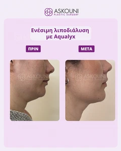 Λιποδιάλυση στο Προγούλι με Aqualyx - Γυναίκα | Πριν & Μετά