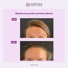 Εξομάλυνση Ρυτίδων Μετώπου | Πριν & Μετά