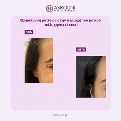 Εξομάλυνση Ρυτίδων Περιοχή Ματιού | Πριν & Μετά