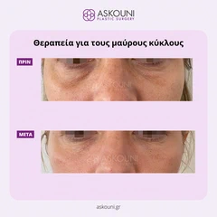 Θεραπεία Μαύρων Κύκλων | Πριν & Μετά