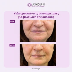 Υαλουρονικό Οξύ - Ρινοπαρειακές | Πριν & Μετά
