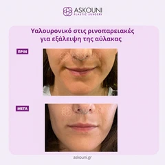 Υαλουρονικό Οξύ - Ρινοπαρειακές | Πριν & Μετά