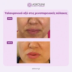Υαλουρονικό Οξύ - Ρινοπαρειακές | Πριν & Μετά
