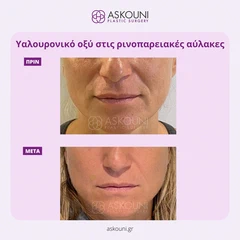 Υαλουρονικό Οξύ - Ρινοπαρειακές | Πριν & Μετά