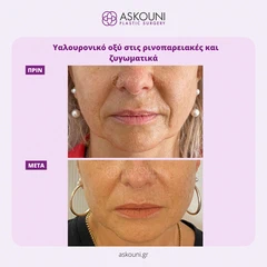 Υαλουρονικό Οξύ - Ρινοπαρειακές | Πριν & Μετά