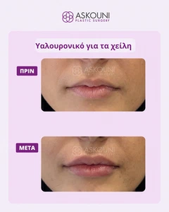 Αυξητική Χειλιών με Filler | Πριν & Μετά