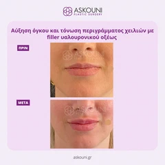 Αυξητική Χειλιών με Filler | Πριν & Μετά