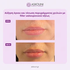 Αυξητική Χειλιών με Filler | Πριν & Μετά