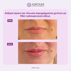Αυξητική Χειλιών με Filler | Πριν & Μετά