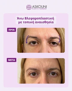 Άνω Βλεφαροπλαστική με Τοπική Αναισθησία - Γυναίκα | Πριν & Μετά