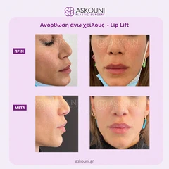 Ανόρθωση Άνω Χείλους | Πριν & Μετά