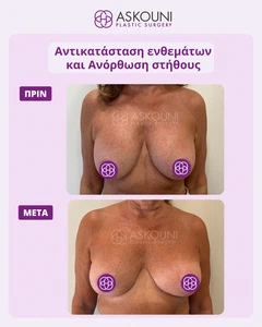Αντικατάσταση Ενθεμάτων & Ανόρθωση Στήθους - 6 Εβδομάδες Μετά | Πριν & Μετά