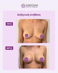 Αυξητική Στήθους | Πριν & Μετά