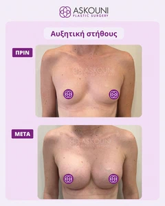Αυξητική Στήθους | Πριν & Μετά