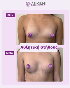 Αυξητική Στήθους | Πριν & Μετά