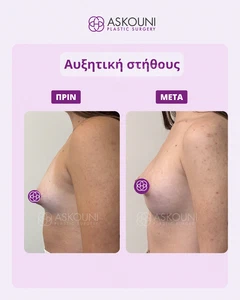 Αυξητική Στήθους | Πριν & Μετά