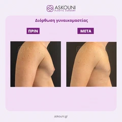 Γυναικομαστία | Πριν & Μετά