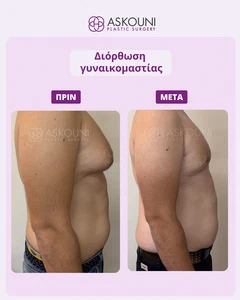 Γυναικομαστία | Πριν & Μετά