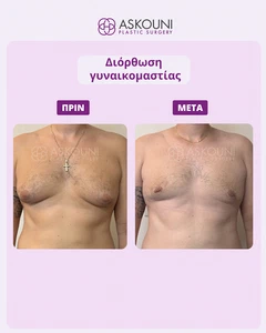 Γυναικομαστία | Πριν & Μετά