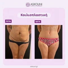 Κοιλιοπλαστική - Γυναίκα | Πριν & Μετά