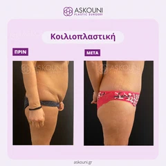 Κοιλιοπλαστική - Γυναίκα | Πριν & Μετά