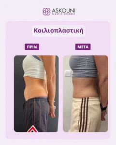 Διορθωτική Κοιλιοπλαστική - Γυναίκα | Πριν & Μετά