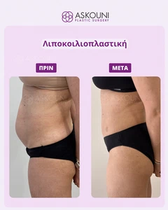 Λιποκοιλιοπλαστική - Γυναίκα - 6 Εβδομάδες | Πριν & Μετά