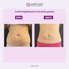 Λιποαναρρόφηση Κοιλιακής Χώρας - Γυναίκα | Πριν & Μετά