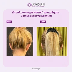Ωτοπλαστική - Γυναίκα | Πριν & Μετά