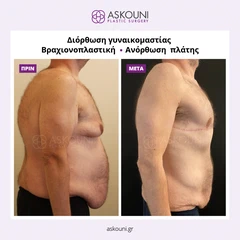 Πλαστική μετά από Απώλεια Βάρους | Πριν & Μετά