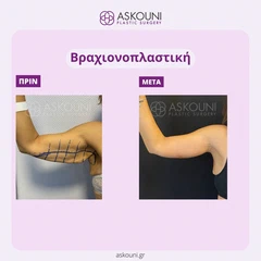 Βραχιονοπλαστική - Γυναίκα | Πριν & Μετά