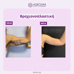Βραχιονοπλαστική - Γυναίκα | Πριν & Μετά