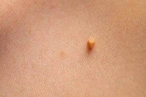 Αφαίρεση Θηλωμάτων ✔