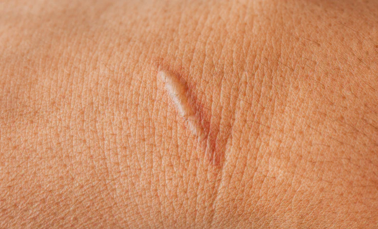 Keloid Scars Treatment