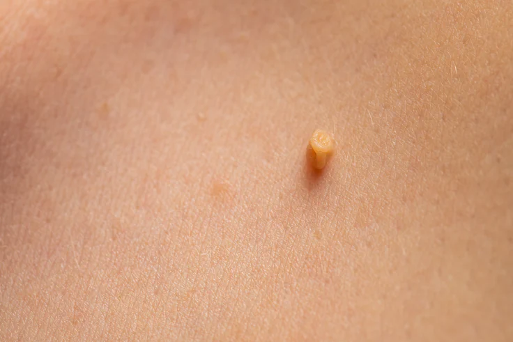 Removal of Skin Tags (Papillomas)
