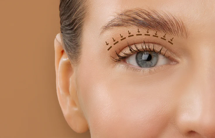 Upper Blepharoplasty
