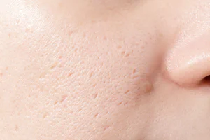 Acne Scars - Microneedling / Dermapen